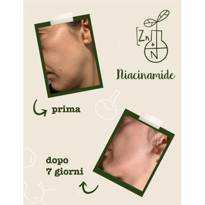 Niacinamide + Zinco Attivo Puro - Siero viso ad azione urto, seboregolatore e anti-imperfezioni